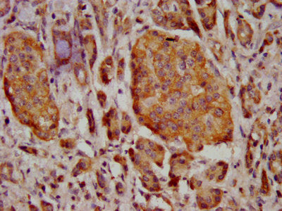 IHC image of CSB-PA04639A0Rb diluted at 1:400 and staining in paraffin-embedded human pancreatic cancer performed on a Leica BondTM system. After dewaxing and hydration, antigen retrieval was mediated by high pressure in a citrate buffer (pH 6.0)....