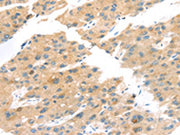 The image on the left is immunohistochemistry of paraffin-embedded Human liver cancer tissue using CSB-PA046438(TNK1 Antibody) at dilution 1/20, on the right is treated with synthetic peptide. (Original magnification: ×200)