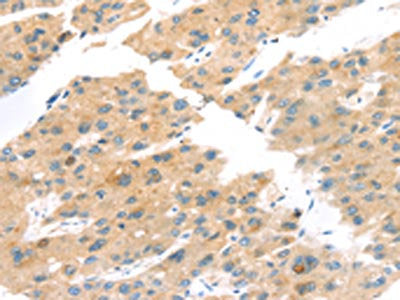 The image on the left is immunohistochemistry of paraffin-embedded Human liver cancer tissue using CSB-PA046438(TNK1 Antibody) at dilution 1/20, on the right is treated with synthetic peptide. (Original magnification: ×200)