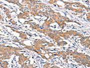 The image on the left is immunohistochemistry of paraffin-embedded Human gastic cancer tissue using CSB-PA046723(DSC1 Antibody) at dilution 1/40, on the right is treated with synthetic peptide. (Original magnification: ×200)