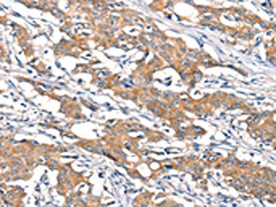 The image on the left is immunohistochemistry of paraffin-embedded Human gastic cancer tissue using CSB-PA046723(DSC1 Antibody) at dilution 1/40, on the right is treated with synthetic peptide. (Original magnification: ×200)