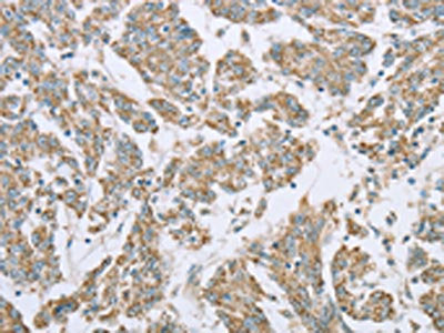 The image on the left is immunohistochemistry of paraffin-embedded Human colon cancer tissue using CSB-PA046947(ECHS1 Antibody) at dilution 1/20, on the right is treated with fusion protein. (Original magnification: ×200)