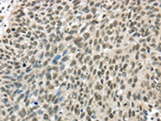 The image on the left is immunohistochemistry of paraffin-embedded Human lung cancer tissue using CSB-PA047135(TBL1Y Antibody) at dilution 1/20, on the right is treated with fusion protein. (Original magnification: ×200)