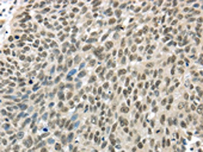 The image on the left is immunohistochemistry of paraffin-embedded Human lung cancer tissue using CSB-PA047135(TBL1Y Antibody) at dilution 1/20, on the right is treated with fusion protein. (Original magnification: ×200)