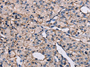 The image on the left is immunohistochemistry of paraffin-embedded Human prostate cancer tissue using CSB-PA047259(EPHA7 Antibody) at dilution 1/20, on the right is treated with synthetic peptide. (Original magnification: ×200)