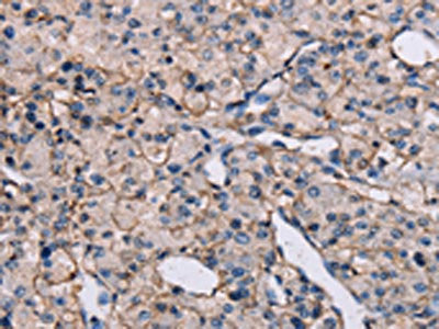 The image on the left is immunohistochemistry of paraffin-embedded Human prostate cancer tissue using CSB-PA047259(EPHA7 Antibody) at dilution 1/20, on the right is treated with synthetic peptide. (Original magnification: ×200)