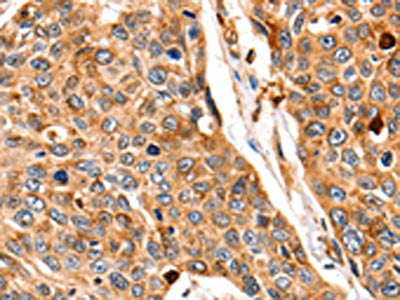 The image on the left is immunohistochemistry of paraffin-embedded Human esophagus cancer tissue using CSB-PA047604(CTSB Antibody) at dilution 1/140, on the right is treated with fusion protein. (Original magnification: ×200)
