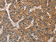 The image on the left is immunohistochemistry of paraffin-embedded Human liver cancer tissue using CSB-PA047722(BRE Antibody) at dilution 1/40, on the right is treated with fusion protein. (Original magnification: ×200)