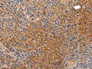 The image on the left is immunohistochemistry of paraffin-embedded Human liver cancer tissue using CSB-PA047815(NOD1 Antibody) at dilution 1/50, on the right is treated with synthetic peptide. (Original magnification: ×200)