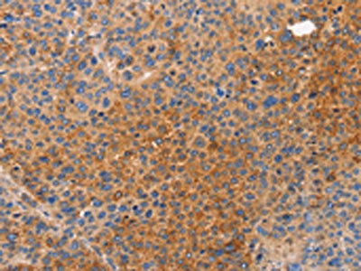 The image on the left is immunohistochemistry of paraffin-embedded Human liver cancer tissue using CSB-PA047815(NOD1 Antibody) at dilution 1/50, on the right is treated with synthetic peptide. (Original magnification: ×200)