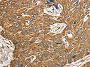 The image on the left is immunohistochemistry of paraffin-embedded Human esophagus cancer tissue using CSB-PA047925(KCNC1 Antibody) at dilution 1/20, on the right is treated with synthetic peptide. (Original magnification: ×200)