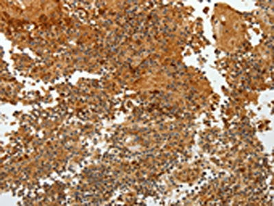 The image on the left is immunohistochemistry of paraffin-embedded Human tonsil tissue using CSB-PA048054(TFF2 Antibody) at dilution 1/40, on the right is treated with fusion protein. (Original magnification: ×200)