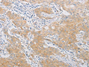 The image on the left is immunohistochemistry of paraffin-embedded Human gastic cancer tissue using CSB-PA048149(PDE4D Antibody) at dilution 1/20, on the right is treated with fusion protein. (Original magnification: ×200)