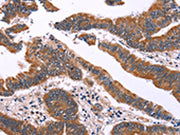 The image on the left is immunohistochemistry of paraffin-embedded Human colon cancer tissue using CSB-PA048353(IRAK1BP1 Antibody) at dilution 1/40, on the right is treated with fusion protein. (Original magnification: ×200)