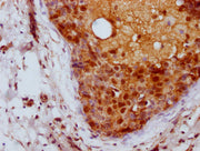 IHC image of CSB-PA04837A0Rb diluted at 1:100 and staining in paraffin-embedded human breast cancer performed on a Leica BondTM system. After dewaxing and hydration, antigen retrieval was mediated by high pressure in a citrate buffer (pH 6.0). Sec...
