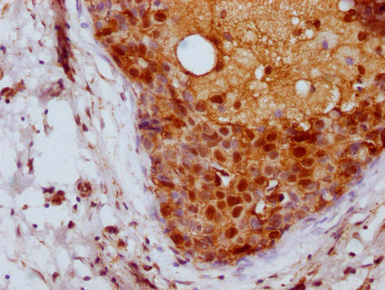 IHC image of CSB-PA04837A0Rb diluted at 1:100 and staining in paraffin-embedded human breast cancer performed on a Leica BondTM system. After dewaxing and hydration, antigen retrieval was mediated by high pressure in a citrate buffer (pH 6.0). Sec...