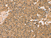 The image on the left is immunohistochemistry of paraffin-embedded Human breast cancer tissue using CSB-PA048402(RPLP2 Antibody) at dilution 1/40, on the right is treated with fusion protein. (Original magnification: ×200)