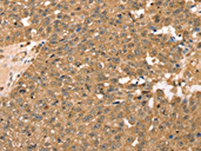 The image on the left is immunohistochemistry of paraffin-embedded Human breast cancer tissue using CSB-PA048402(RPLP2 Antibody) at dilution 1/40, on the right is treated with fusion protein. (Original magnification: ×200)