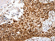 The image on the left is immunohistochemistry of paraffin-embedded Human esophagus cancer tissue using CSB-PA048443(SNX15 Antibody) at dilution 1/20, on the right is treated with fusion protein. (Original magnification: ×200)