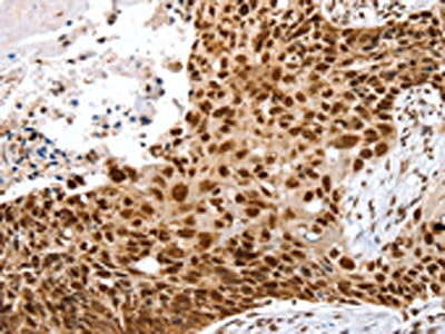 The image on the left is immunohistochemistry of paraffin-embedded Human esophagus cancer tissue using CSB-PA048443(SNX15 Antibody) at dilution 1/20, on the right is treated with fusion protein. (Original magnification: ×200)