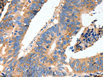 The image on the left is immunohistochemistry of paraffin-embedded Human colon cancer tissue using CSB-PA048458(MUC6 Antibody) at dilution 1/40, on the right is treated with synthetic peptide. (Original magnification: ×200)