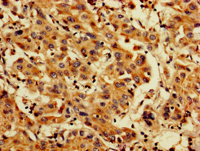 IHC image of CSB-PA04874A0Rb diluted at 1:200 and staining in paraffin-embedded human liver cancer performed on a Leica BondTM system. After dewaxing and hydration, antigen retrieval was mediated by high pressure in a citrate buffer (pH 6.0). Sect...