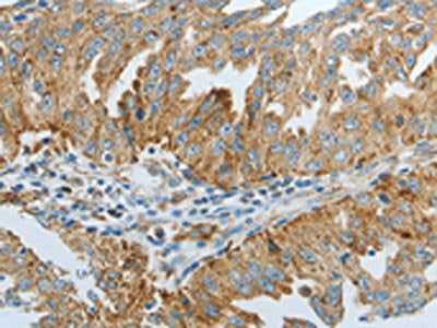 The image on the left is immunohistochemistry of paraffin-embedded Human ovarian cancer tissue using CSB-PA048817(DNAJC10 Antibody) at dilution 1/20, on the right is treated with fusion protein. (Original magnification: ×200)