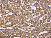 The image on the left is immunohistochemistry of paraffin-embedded Human liver cancer tissue using CSB-PA048892(IFNA2 Antibody) at dilution 1/40, on the right is treated with synthetic peptide. (Original magnification: ×200)