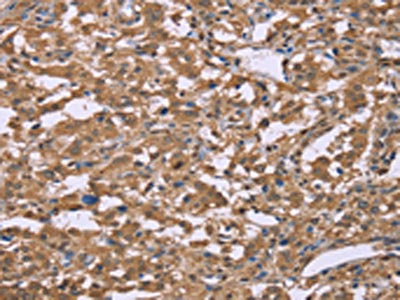 The image on the left is immunohistochemistry of paraffin-embedded Human liver cancer tissue using CSB-PA048892(IFNA2 Antibody) at dilution 1/40, on the right is treated with synthetic peptide. (Original magnification: ×200)