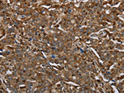 The image on the left is immunohistochemistry of paraffin-embedded Human liver cancer tissue using CSB-PA048999(ARHGDIA Antibody) at dilution 1/30, on the right is treated with fusion protein. (Original magnification: ×200)