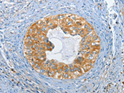 The image on the left is immunohistochemistry of paraffin-embedded Human cervical cancer tissue using CSB-PA049170(DGKZ Antibody) at dilution 1/60, on the right is treated with synthetic peptide. (Original magnification: ×200)