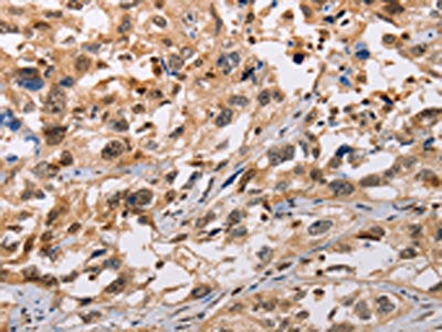 The image on the left is immunohistochemistry of paraffin-embedded Human esophagus cancer tissue using CSB-PA049233(ADAMDEC1 Antibody) at dilution 1/20, on the right is treated with fusion protein. (Original magnification: ×200)
