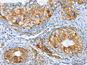 The image on the left is immunohistochemistry of paraffin-embedded Human cervical cancer tissue using CSB-PA049334(AIP Antibody) at dilution 1/80, on the right is treated with synthetic peptide. (Original magnification: ×200)
