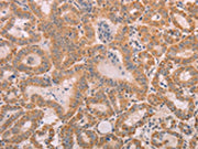 The image on the left is immunohistochemistry of paraffin-embedded Human thyroid cancer tissue using CSB-PA049349(SMAD5 Antibody) at dilution 1/25, on the right is treated with fusion protein. (Original magnification: ×200)