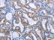 The image on the left is immunohistochemistry of paraffin-embedded Human thyroid cancer tissue using CSB-PA049381(FHIT Antibody) at dilution 1/25, on the right is treated with fusion protein. (Original magnification: ×200)