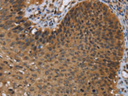 The image on the left is immunohistochemistry of paraffin-embedded Human cervical cancer tissue using CSB-PA049538(UHRF2 Antibody) at dilution 1/20, on the right is treated with synthetic peptide. (Original magnification: ×200)