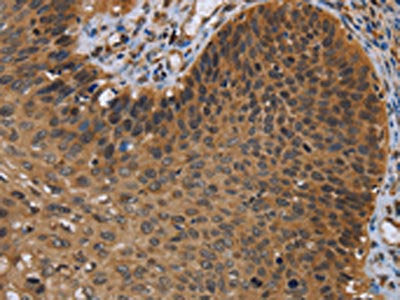 The image on the left is immunohistochemistry of paraffin-embedded Human cervical cancer tissue using CSB-PA049538(UHRF2 Antibody) at dilution 1/20, on the right is treated with synthetic peptide. (Original magnification: ×200)