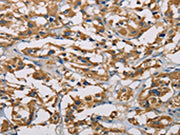 The image on the left is immunohistochemistry of paraffin-embedded Human thyroid cancer tissue using CSB-PA049702(PIP4K2A Antibody) at dilution 1/50, on the right is treated with fusion protein. (Original magnification: ×200)