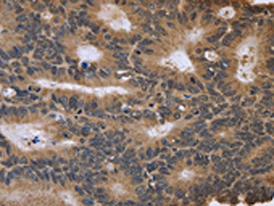 The image on the left is immunohistochemistry of paraffin-embedded Human colon cancer tissue using CSB-PA049737(FGFR1OP2 Antibody) at dilution 1/40, on the right is treated with fusion protein. (Original magnification: ×200)