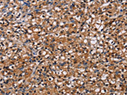 The image on the left is immunohistochemistry of paraffin-embedded Human prostate cancer tissue using CSB-PA049852(NPM3 Antibody) at dilution 1/60, on the right is treated with fusion protein. (Original magnification: ×200)