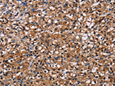 The image on the left is immunohistochemistry of paraffin-embedded Human prostate cancer tissue using CSB-PA049852(NPM3 Antibody) at dilution 1/60, on the right is treated with fusion protein. (Original magnification: ×200)