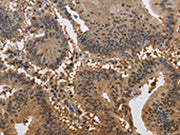 The image on the left is immunohistochemistry of paraffin-embedded Human colon cancer tissue using CSB-PA049990(JAG2 Antibody) at dilution 1/30, on the right is treated with synthetic peptide. (Original magnification: ×200)