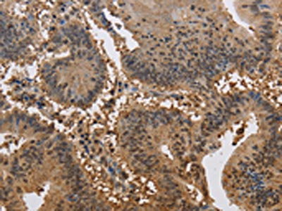 The image on the left is immunohistochemistry of paraffin-embedded Human colon cancer tissue using CSB-PA049990(JAG2 Antibody) at dilution 1/30, on the right is treated with synthetic peptide. (Original magnification: ×200)