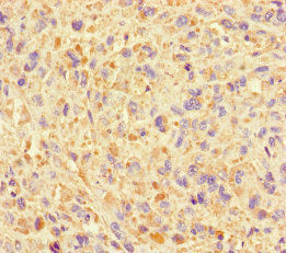 Immunohistochemistry of paraffin-embedded human melanoma using CSB-PA05009A0Rb at dilution of 1:100