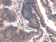The image on the left is immunohistochemistry of paraffin-embedded Human colon cancer tissue using CSB-PA050337(FAIM Antibody) at dilution 1/25, on the right is treated with synthetic peptide. (Original magnification: ×200)