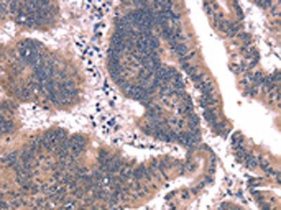 The image on the left is immunohistochemistry of paraffin-embedded Human colon cancer tissue using CSB-PA050337(FAIM Antibody) at dilution 1/25, on the right is treated with synthetic peptide. (Original magnification: ×200)