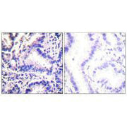 Immunohistochemical analysis of paraffin-embedded human lung carcinoma tissue using Synuclein γ antibody.