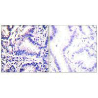 Immunohistochemical analysis of paraffin-embedded human lung carcinoma tissue using Synuclein γ antibody.