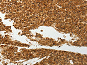 The image on the left is immunohistochemistry of paraffin-embedded Human liver cancer tissue using CSB-PA050626(SOCS7 Antibody) at dilution 1/30, on the right is treated with synthetic peptide. (Original magnification: ×200)