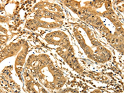 The image on the left is immunohistochemistry of paraffin-embedded Human gastic cancer tissue using CSB-PA050885(RAB26 Antibody) at dilution 1/60, on the right is treated with synthetic peptide. (Original magnification: ×200)